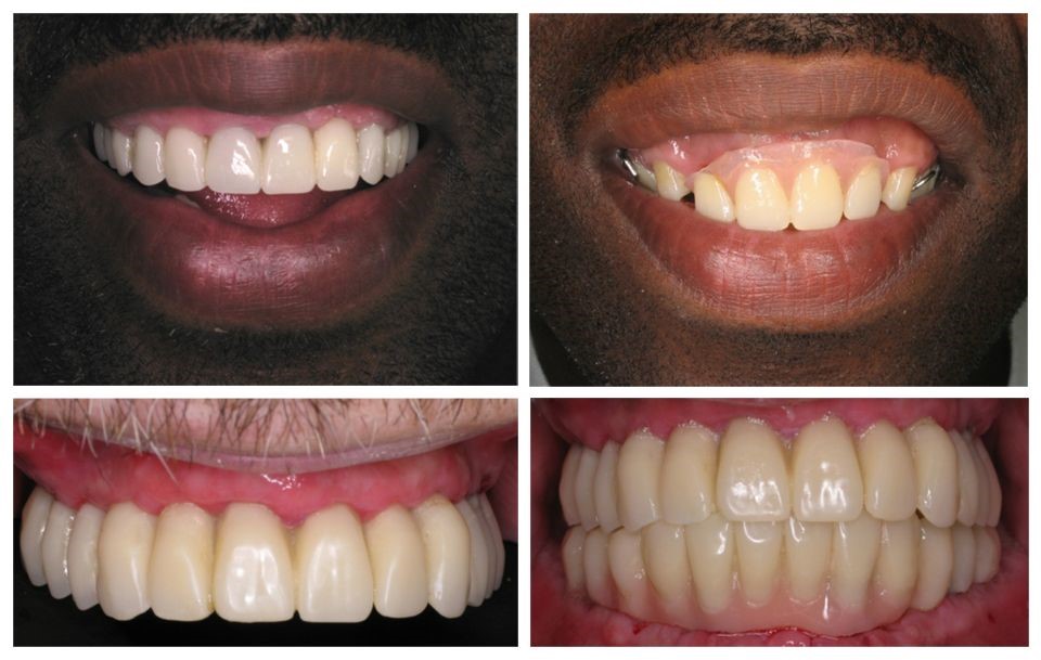 Partial 
      Dentures Before And After Atlanta GA 30346